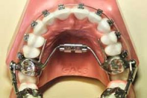 expander palatal repositioning jaw expand